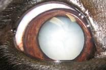 Cataract